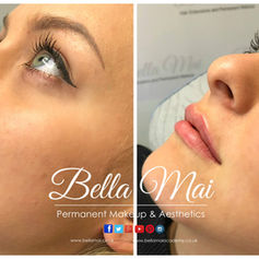 Natural lip dermal filler before & after Bella Mai Essex