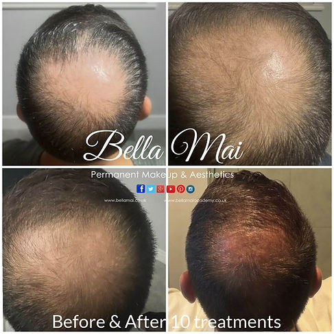 Derma 2 Hair Microneedling before and after results for crown thinning after 10 treatments at Bella Mai clinic in Grays, Essex.