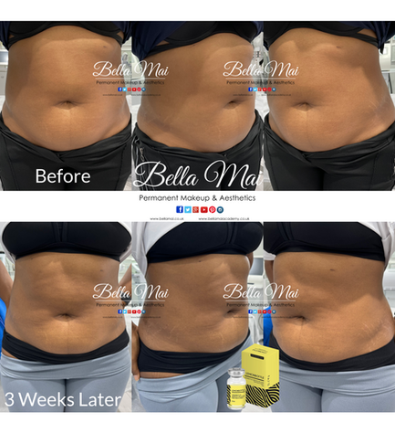 Lemon Bottle Stomach contouring results Bella Mai Essex