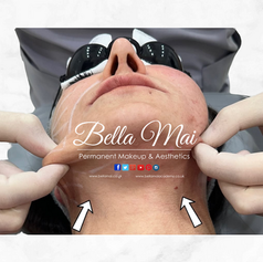 Before and after Endolaser face fat melting and skin tightening results - Bella Mai Essex