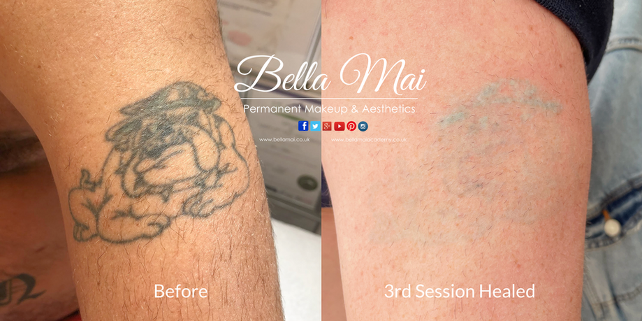 Laser tattoo removal before and after results Grays Essex