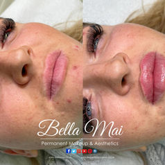 Russian Lip Filler Filler Training in Thurrock, Essex. Bella Mai Academy