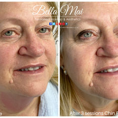 Before and after double chin fat freezing results at Bella Mai Essex.