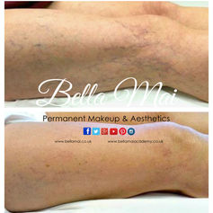 Sclerotherapy leg vein removal results Essex