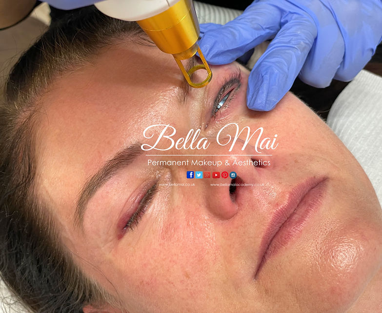 Before and after results of laser eyeliner tattoo removal for migrated ink Grays clinic