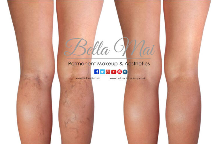 Sclerotherapy leg vein removal results Essex