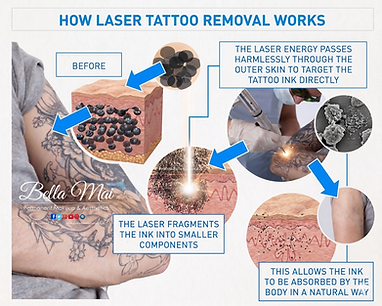 Laser tattoo removal before and after results Grays Essex
