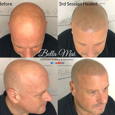 Scalp micropigmentation before and after full scalp Grays Essex