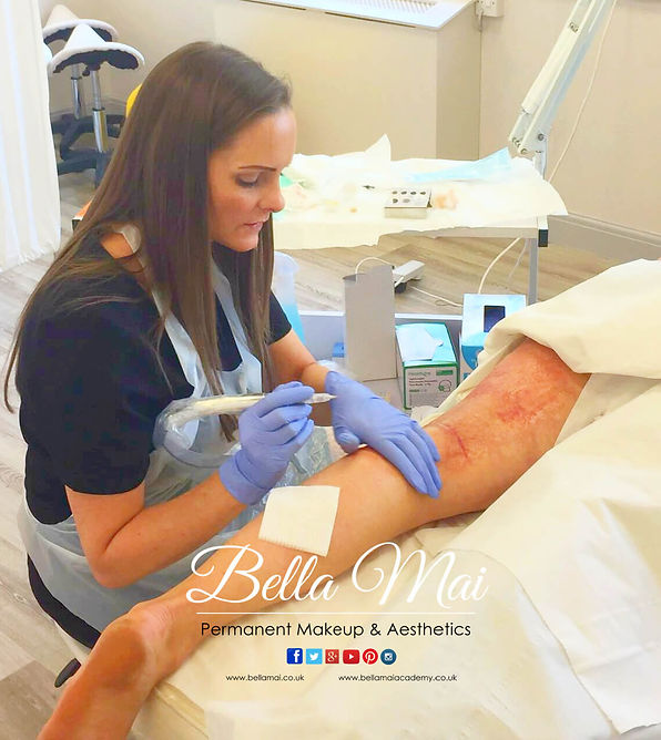 Dry needling for scar texture improvement Bella Mai Grays