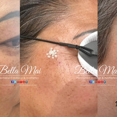 laser skin rejuvenation Before and after sun damage and pigmentation removal Grays