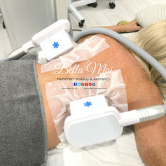 Cryolipolysis fat reduction on back fat - Bella Mai Essex body contouring.