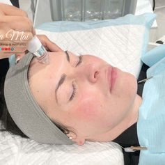 Hydro Facial results Essex