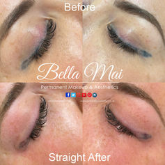 Before and after results of laser eyeliner tattoo removal for migrated ink Grays Essex