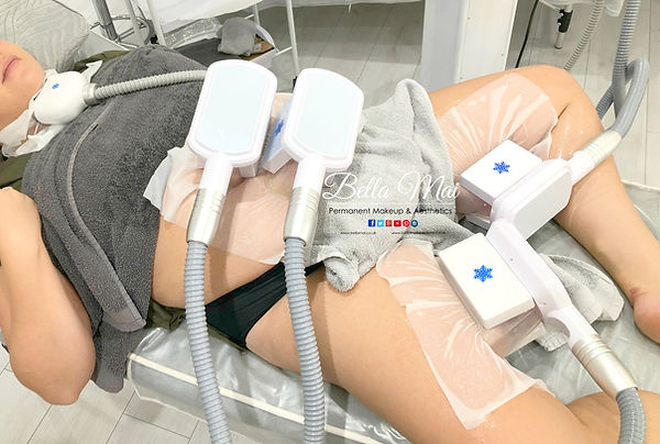 Cryolipolysis fat reduction on abdomen, inside legs and chin - Bella Mai Essex body contouring.