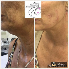 Before and after PDO neck thread lift treatment showing skin tightening and improved neck definition on mature client