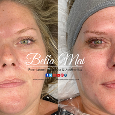 Hydro Facial results Essex