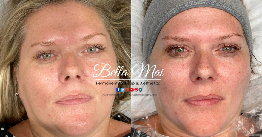 Hydro Facial results Essex