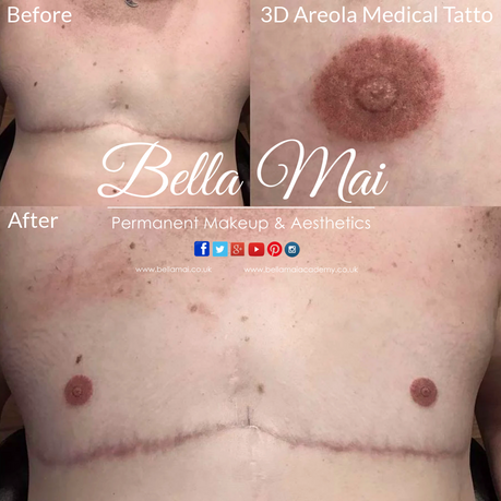 FTM top surgery scar camouflage medical tattooing Bella Mai Essex