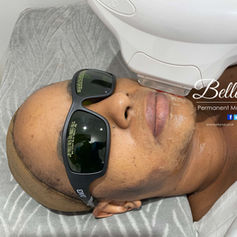 laser skin rejuvenation Before and after sun damage and pigmentation removal Grays