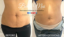 Before and after non-surgical body contouring and fat reduction treatment results in Grays Essex