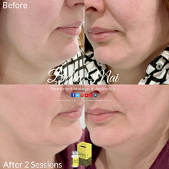 Lemon Bottle Chin contouring results Bella Mai Essex