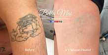 Laser tattoo removal before and after treatment progress at Bella Mai laser clinic Essex