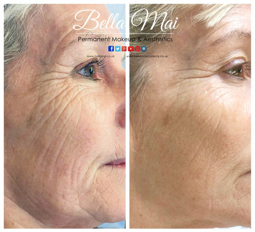 Profhilo BAP injection points for facial lifting Grays Essex