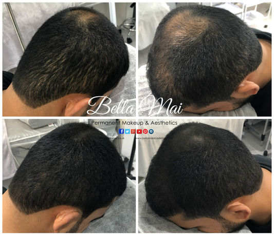 Scalp micropigmentation before and after full scalp Grays Essex