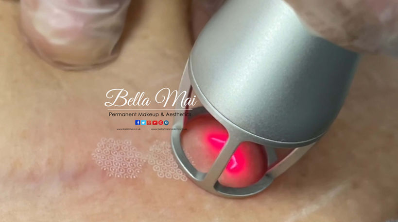 Fractional CO2 Laser Scar Reduction Essex