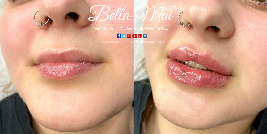Natural lip filler Bella Mai Essex