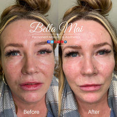 Liquid Facelift results before and after Grays Essex