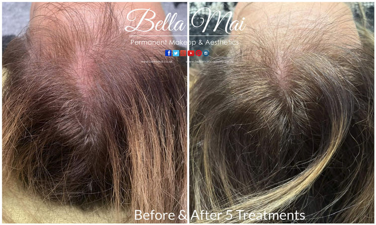Scalp microneedling for natural hair regrowth and thinning hair Essex