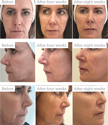 Profhilo BAP injection points for facial lifting Grays Essex
