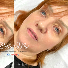 Nasolabial folds and marionette lines contouring with dermal fillers Bella Mai Essex