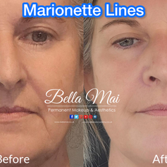 Marionette Lines contouring with dermal fillers Bella Mai Essex