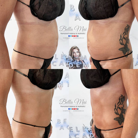 Brazilian Lymphatic Drainage massage before and after Grays Essex