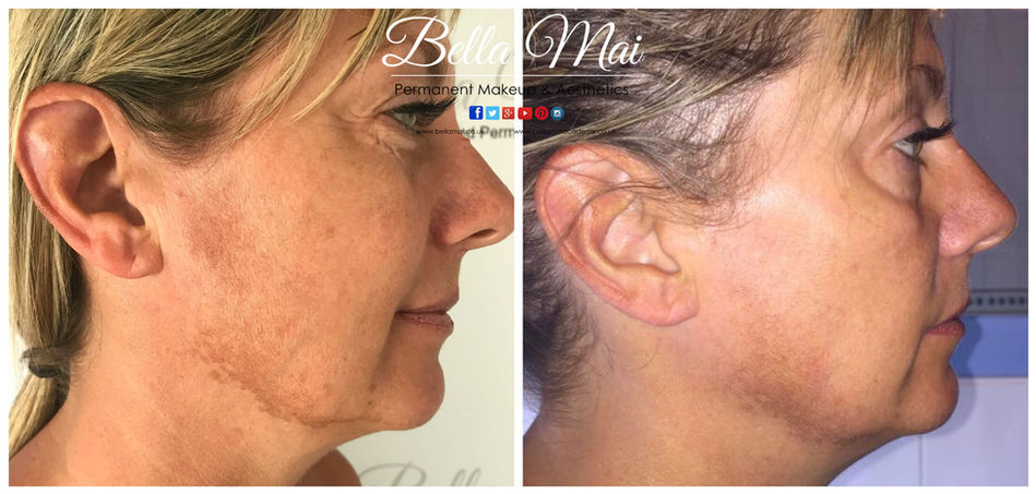 Derma Whitening microneedling treatment for sun damage and melasma Grays