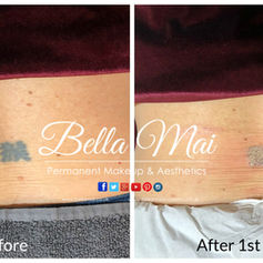 Laser tattoo removal before and after back results Grays Essex