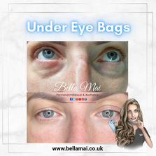Non-surgical under eye bag and dark circle treatment in Grays, Thurrock.
