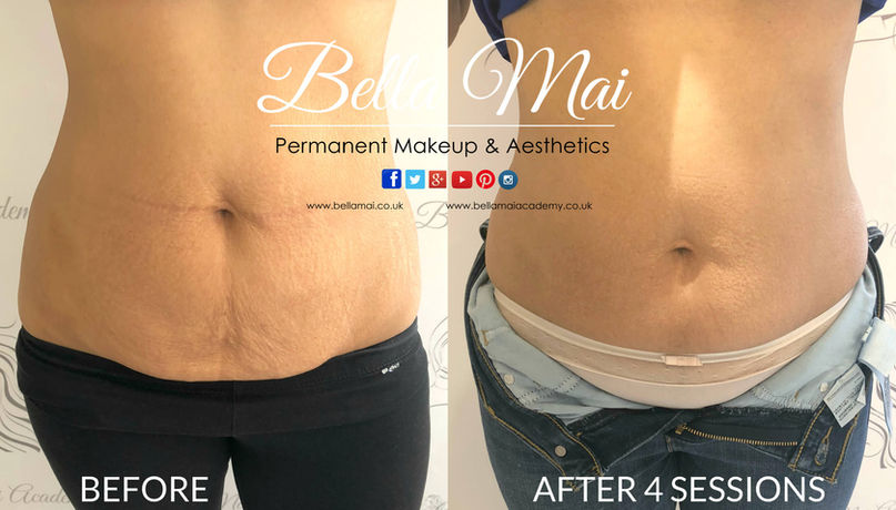 Stomach skin tightening after weight loss - RF treatment Grays