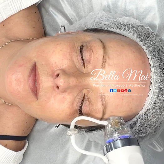 RF Microneedling before and after results Grays Essex