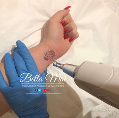 Laser tattoo removal wrist Grays Essex