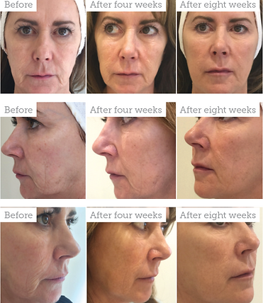 Profhilo BAP injection points for facial lifting Grays Essex