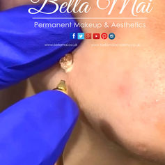 CryoPen wart removal before and after results Grays Essex