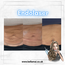 Endolaser non-surgical skin tightening and fat reduction in Grays, Essex.