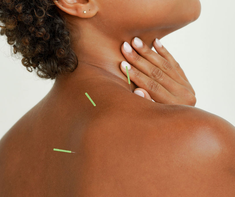 Acupuncture