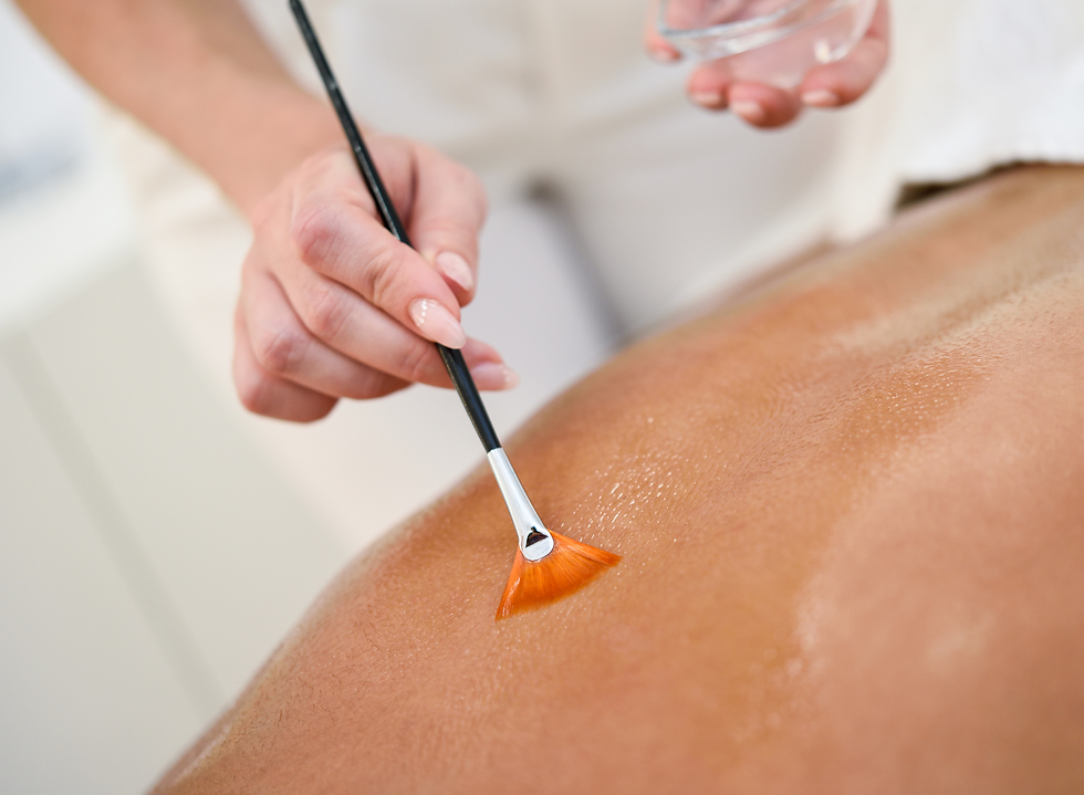 Diamond Peel & IPL Back Treatment