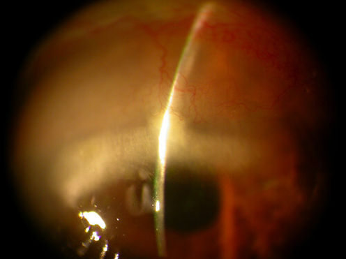 Cornea_degenerations
