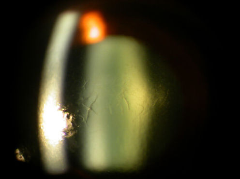 Cornea_degenerations