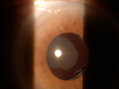 _ATLAS_4_9_post_cataract_intrinsic_PCIOL